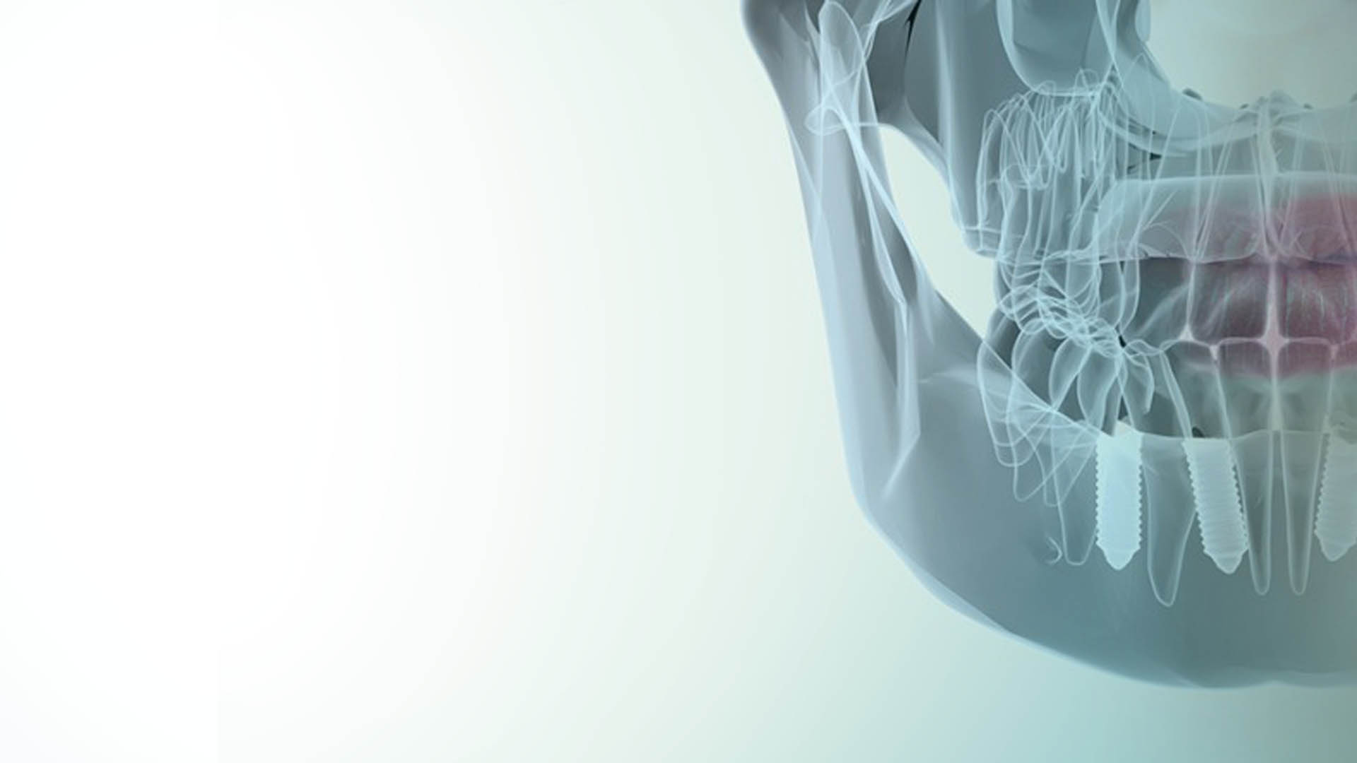 Implantología Dental con Planificación digital